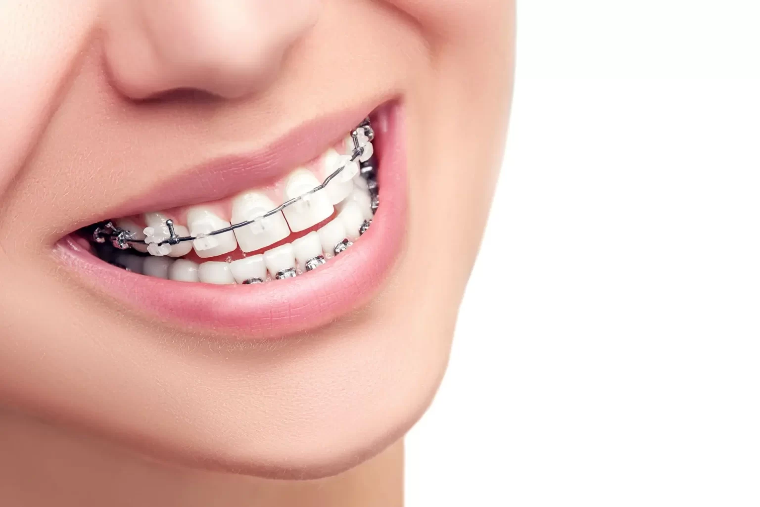 DIFFERENCE BETWEEN CONVENTIONAL BRACES & SELF LIGATING BRACES - Peach