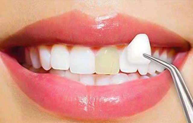Cosmetic Dentistry Options cosmetic dentistry