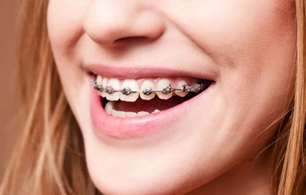 dental braces