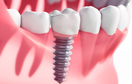 dental implant