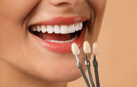 smile makeover