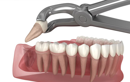 wisdom tooth removal