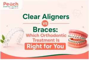 News Corner Clear aligners vs braces comparison showing invisible aligners and traditional metal braces for orthodontic treatment