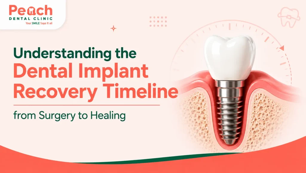 Understanding the Dental Implant Recovery Timeline from Surgery to Healing Illustration of a dental implant placed in the jawbone, representing the dental implant recovery timeline from surgery to complete healing.