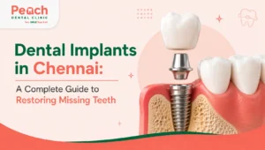 News Corner Dental implants in Chennai showing a titanium implant and crown for restoring missing teeth