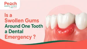 News Corner Illustration of swollen gums around one tooth showing gum inflammation, highlighting a possible dental emergency and the need for prompt dental care.