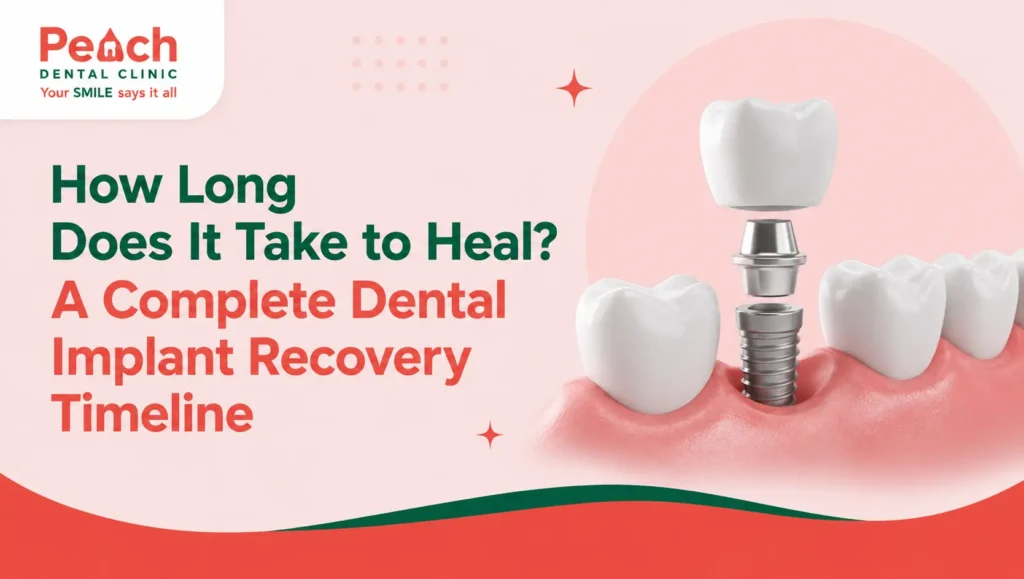 How Long Does It Take to Heal? A Complete Dental Implant Recovery Timeline 3D illustration of a dental implant with crown, abutment, and titanium implant placed in the gum, representing the complete dental implant recovery timeline and healing process.