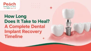 News Corner 3D illustration of a dental implant with crown, abutment, and titanium implant placed in the gum, representing the complete dental implant recovery timeline and healing process.