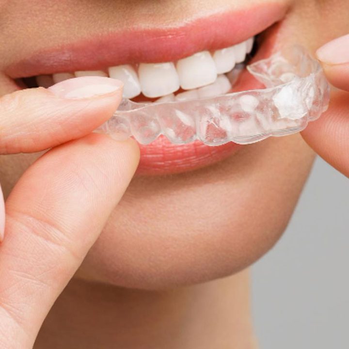 clear aligners peach dental clinic