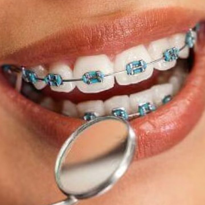 dental braces