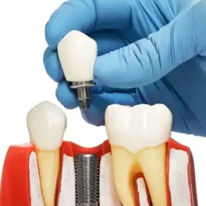 dental implants