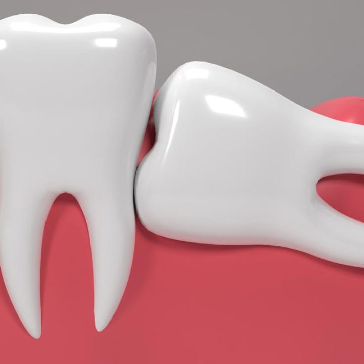 wisdom tooth
